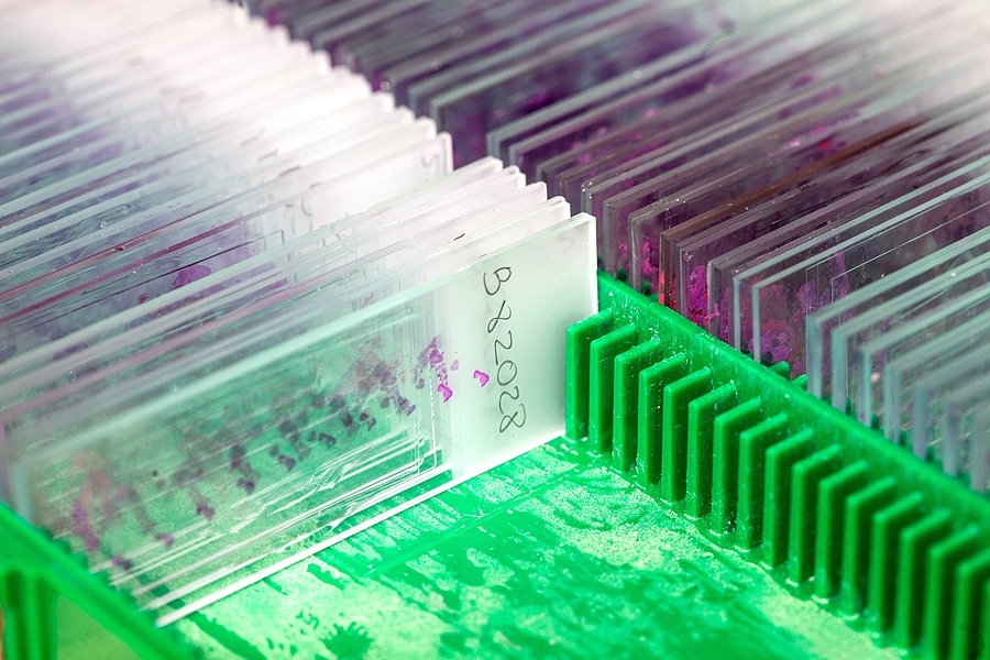 Box of stained tissue biopsy glass slides in pathology laboratory